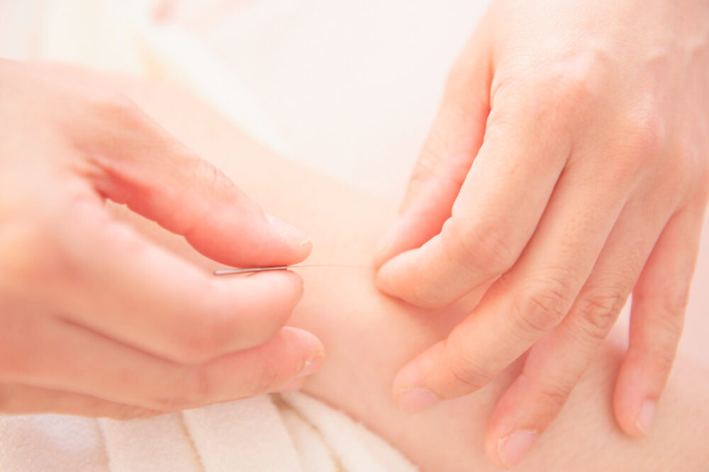手と鍼